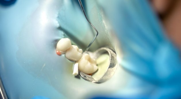 Coronas en CDMX: Restaura tu sonrisa con la mejor especialidad odontológica
