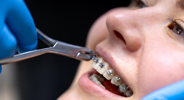 Ferulización con ligadura en CDMX: Un tratamiento especializado en Odontología