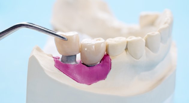 Prótesis en CDMX: Restaura tu sonrisa con nuestra especialidad en Odontología