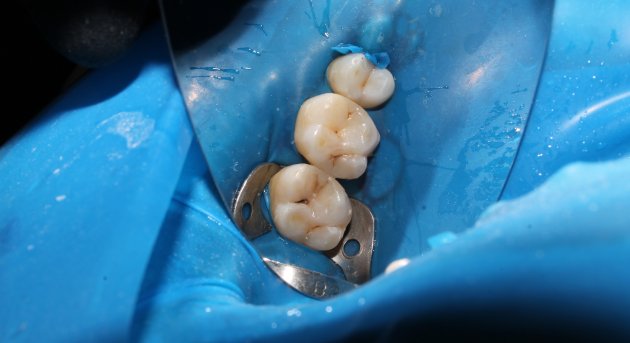 Pulpotomía en CDMX: Un procedimiento para preservar la salud dental